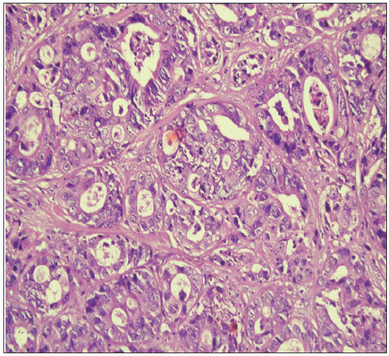 The malignant glands under higher magnification show a lining of atypical columnar epithelium showing nuclear stratification and mild nuclear pleomorphism. (Haematoxylin and eosin, 20x).